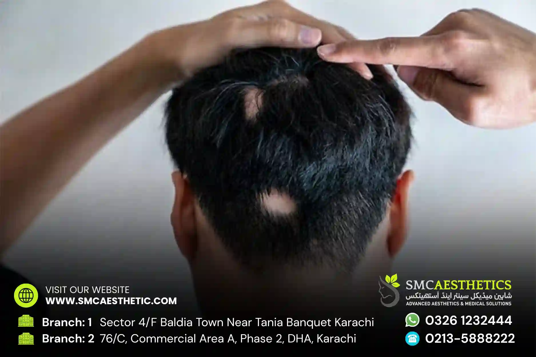 Alopecia Treatment in Karachi - Medical Hair Loss Solutions at SMC Aesthetics